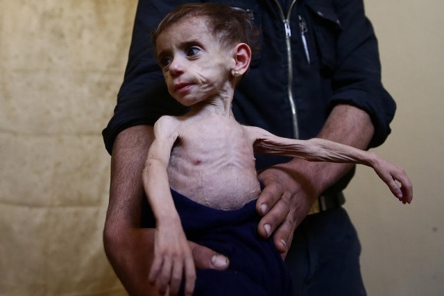 Bi kịch những em bé suy dinh dưỡng tại Đông Damascus | baotintuc.vn