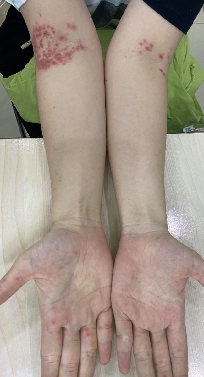 Hy hữu một phụ nữ 32 tuổi mắc bệnh tay chân miệng | baotintuc.vn