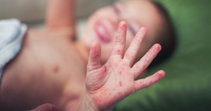 Trẻ bị tay chân miệng trở nặng vì chủng vi rút nguy hiểm tái xuất hiện - Ảnh 2.