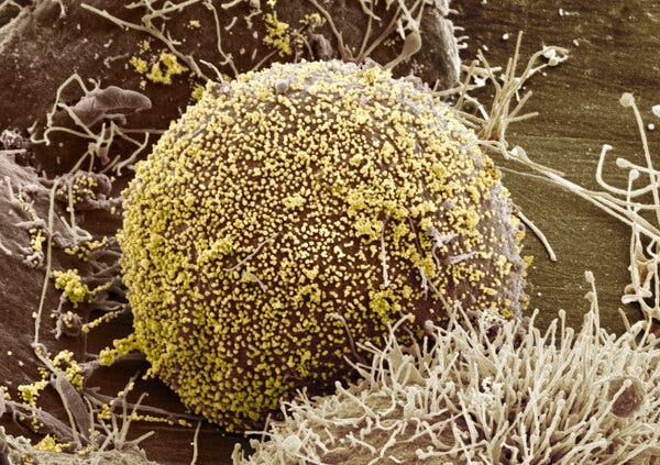 Người phụ nữ đầu tiên trên thế giới khỏi HIV nhờ liệu pháp cấy tế bào gốc - Ảnh 1.