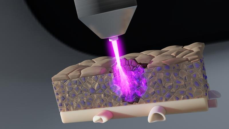 Tia plasma lạnh tiêu diệt tế bào ung thư ẩn sâu